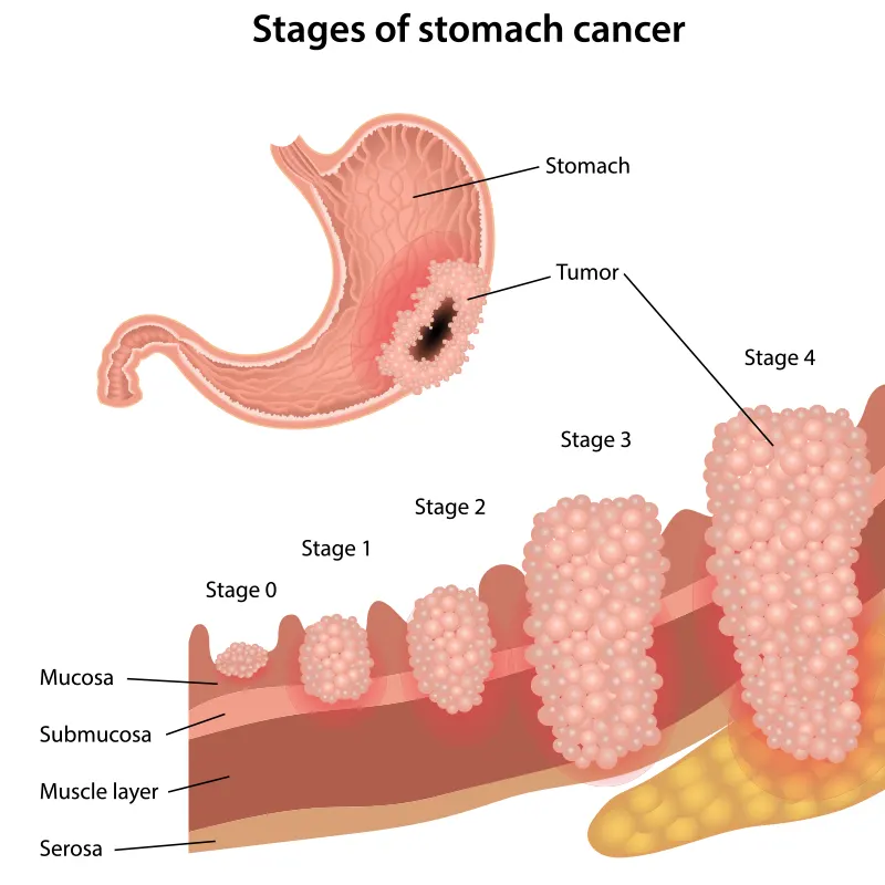 στάδια καρκίνου του στομάχου