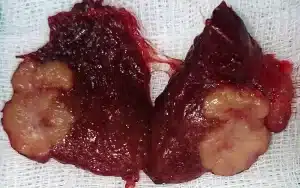 θηλώδης καρκινος θυρεοειδους