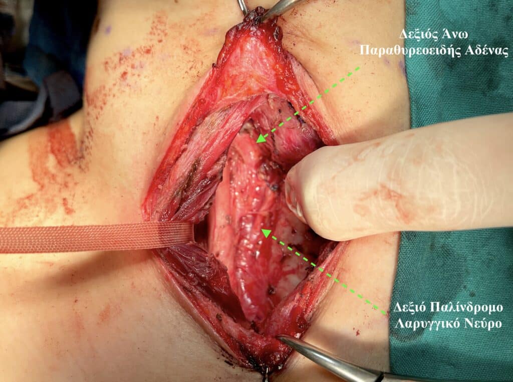 Μυελοειδής καρκίνος θυρεοειδούς κεντρικός λεμφαδενικός καθαρισμός