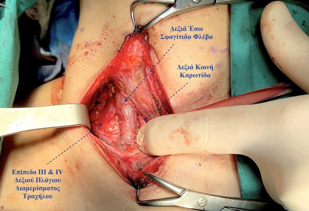Μυελοειδές καρκίνωμα πλάγιος λεμφαδενικός καθαρισμός τραχήλου