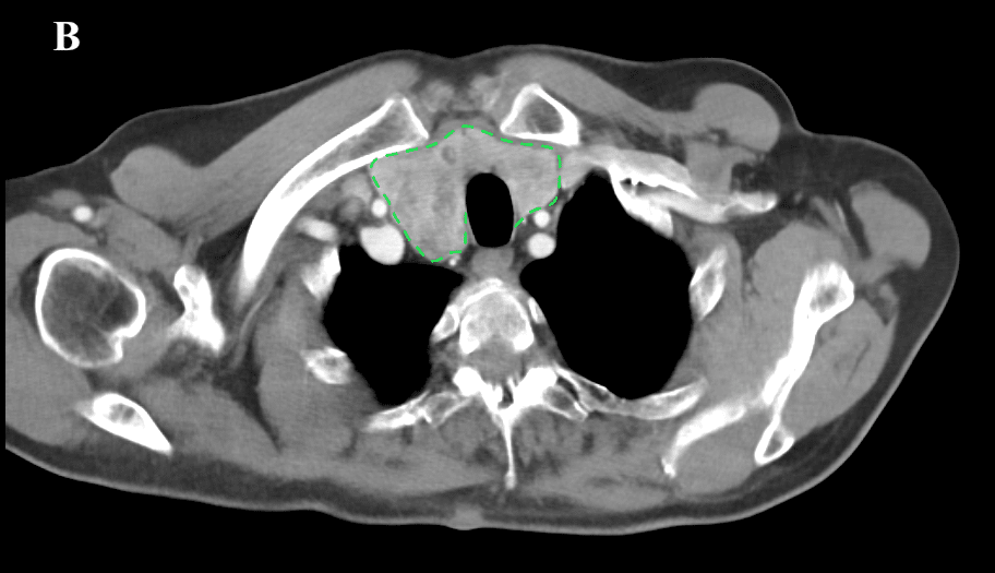 οπισθοστερνική βρογχοκήλη στο επίπεδο των κλειδών