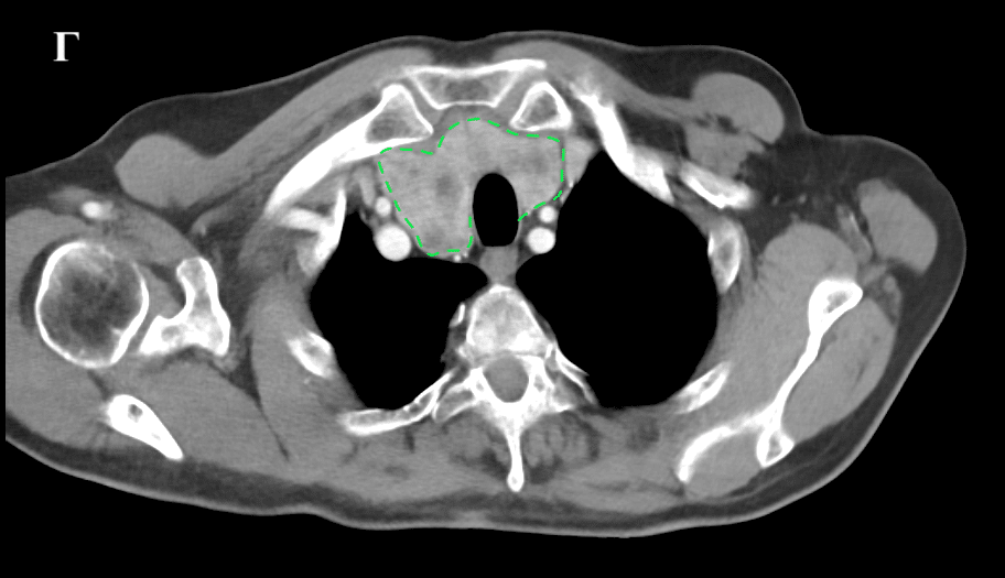 οπισθοστερνική βρογχοκήλη στο επίπεδο της λαβής του στέρνου