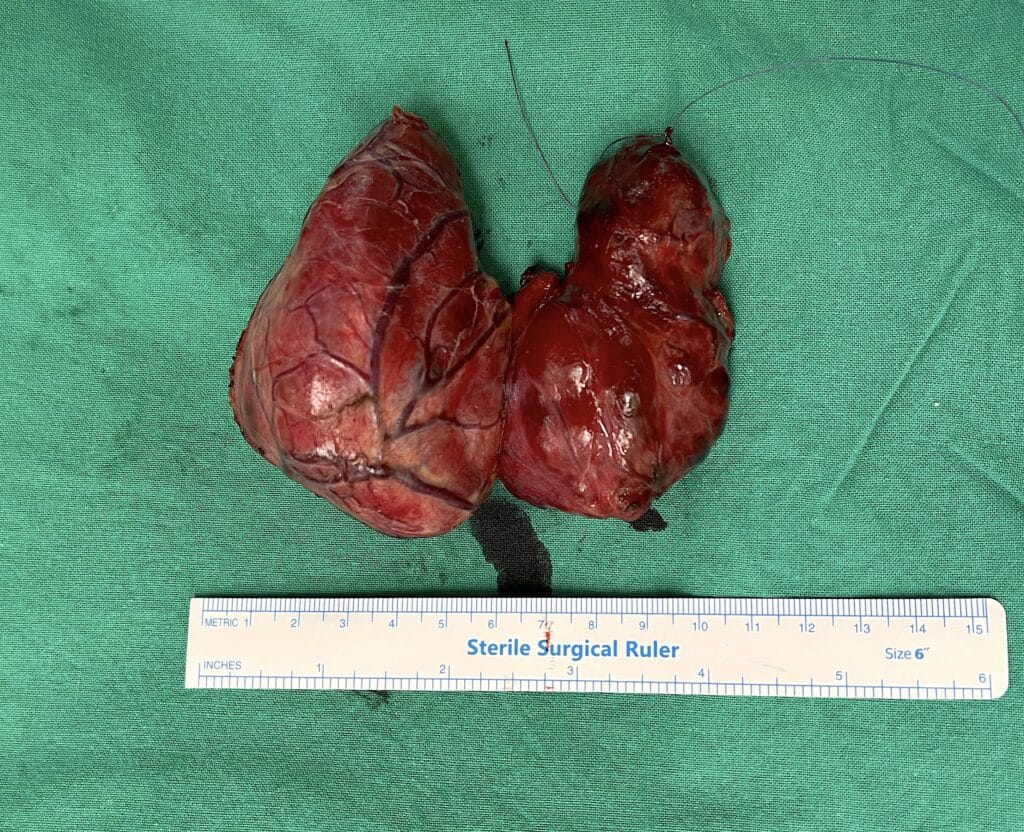 Οπισθοστερνική Βρογχοκήλη χειρουργείο