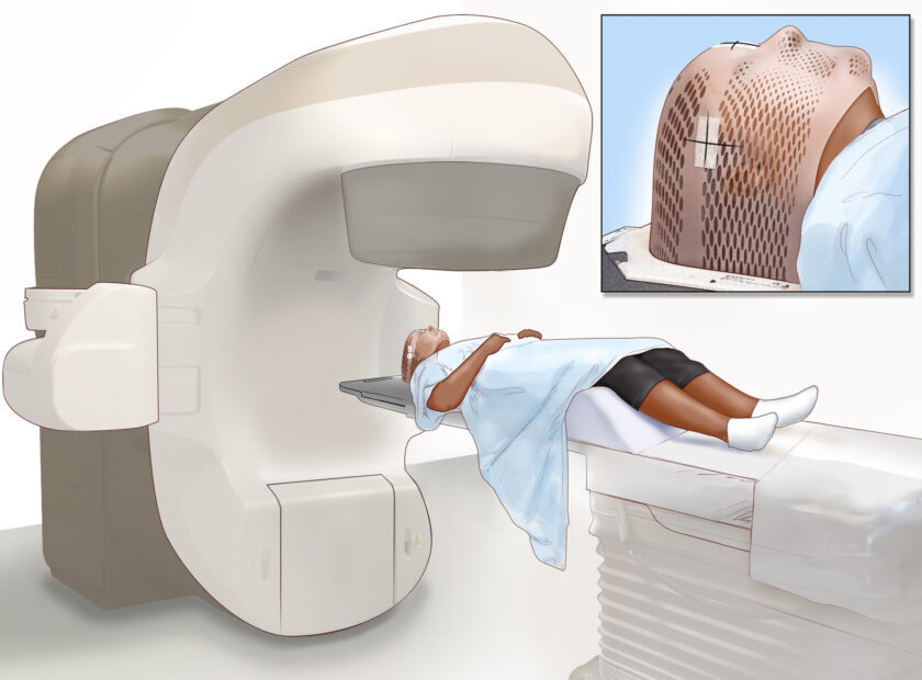 External-Beam Radiation Therapy for the Brain