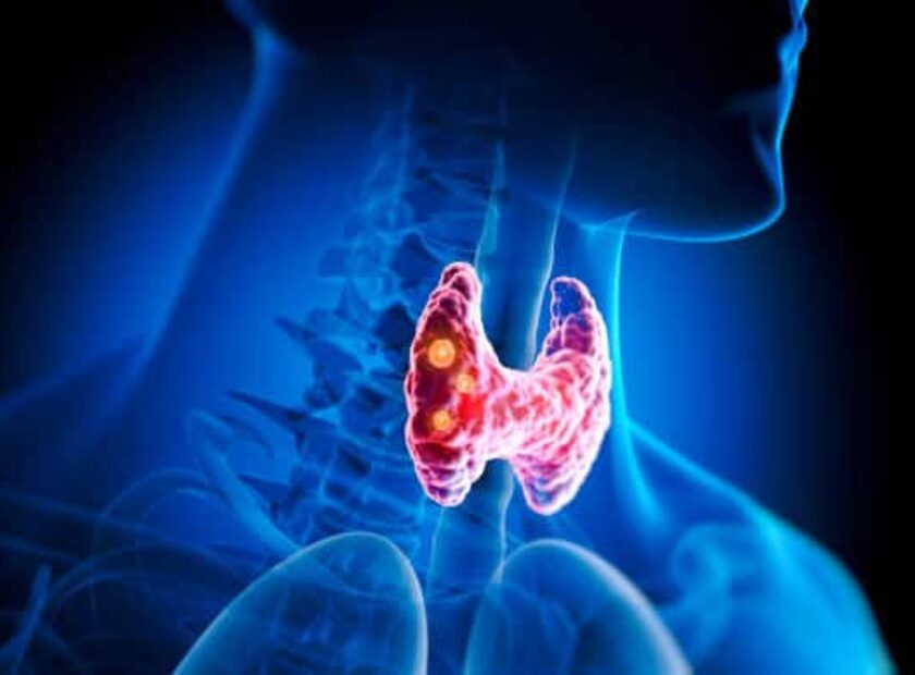 Thyroid gland with nodules inside human body - 3D illustration
