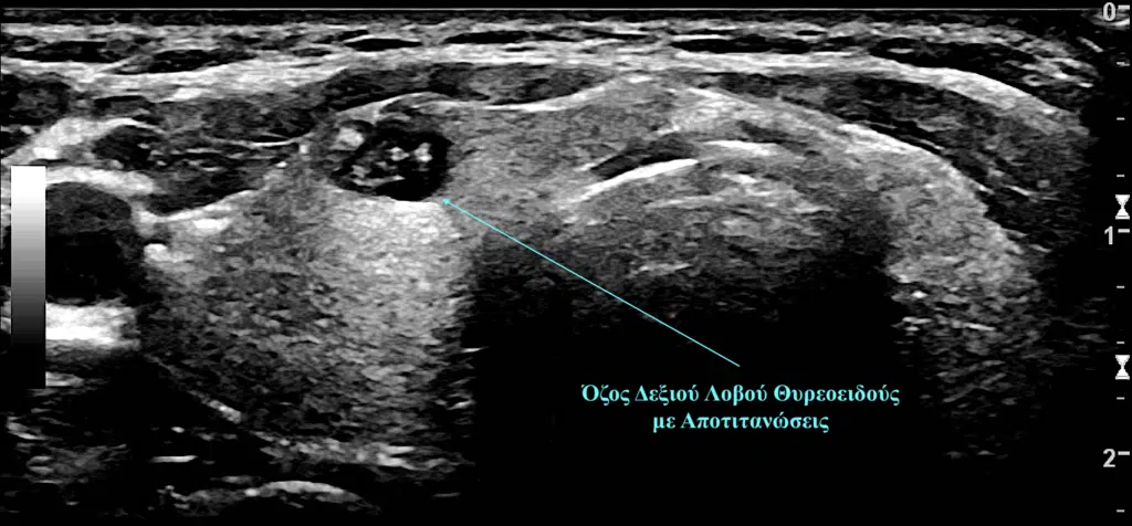ποτε οι οζοι θυρεοειδους ειναι επικινδυνοι