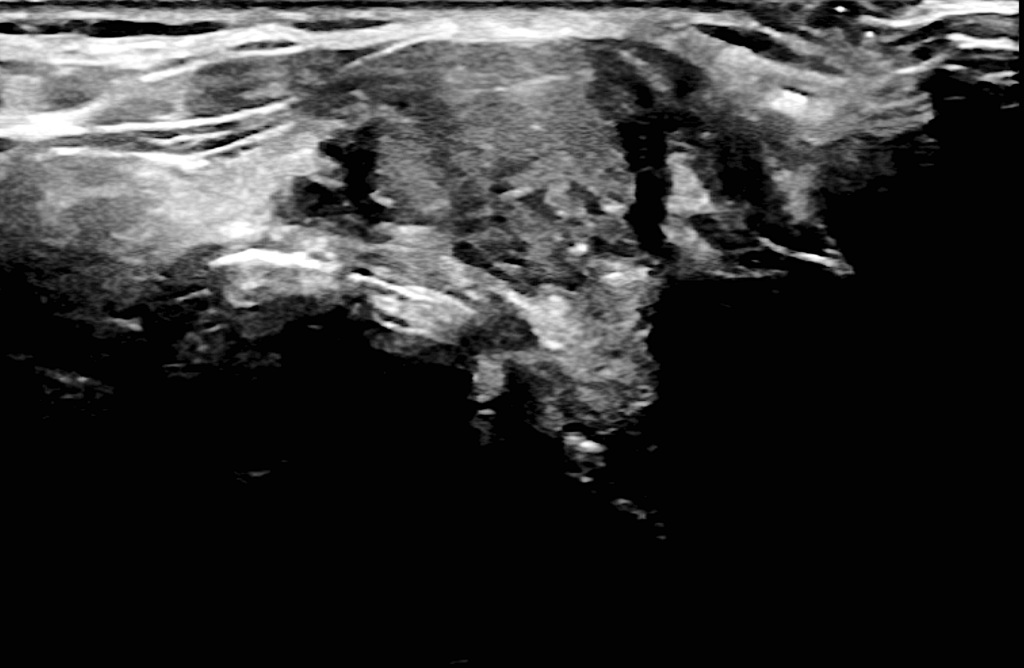 επικίνδυνοι όζοι θυρεοειδούς