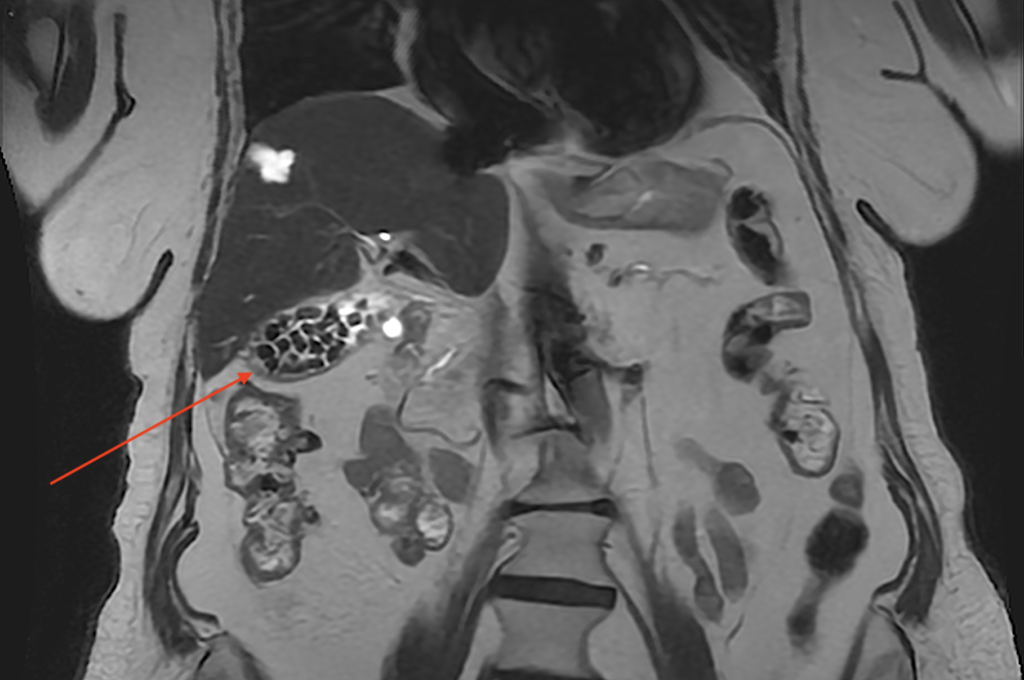 πέτρα στη χολή