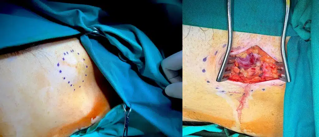 βιοψία λεμφαδένα μασχάλης αριστερά