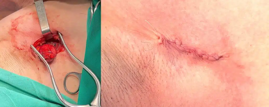 βιοψια λεμφαδενα στη μασχαλη