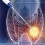 Αφαίρεση Όζου Θυρεοειδούς με Λέιζερ