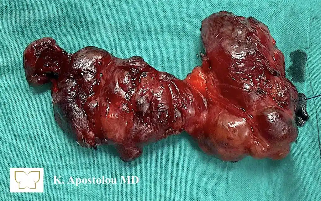 τριπλό αδένωμα παραθυρεοειδούς βρογχοκήλη