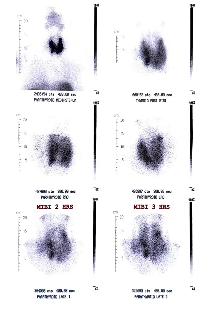 τριπλό αδένωμα παραθυρεοειδούς