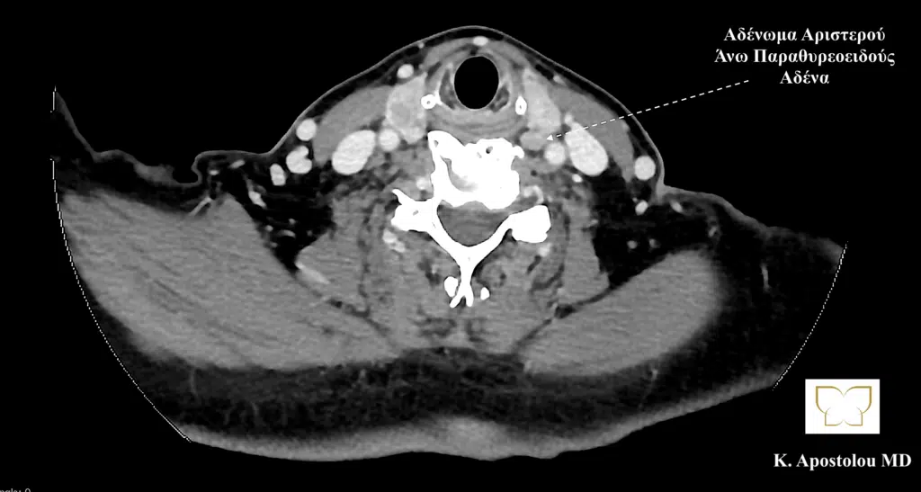 αδενωμα αριστερου ανω παραθυρεοειδους