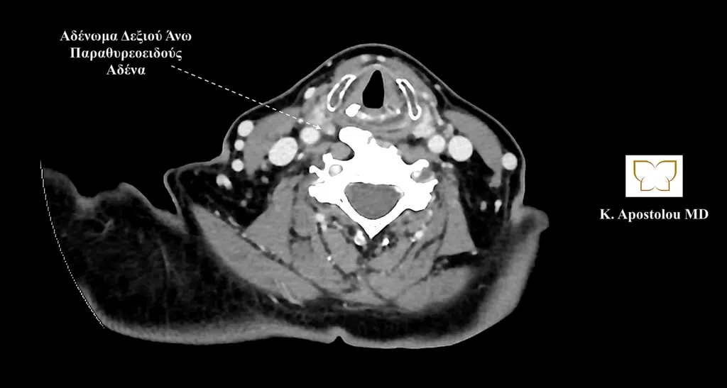 αδενωμα δεξιου ανω παραθυρεοειδους