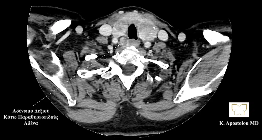 αδενωμα δεξιου κατω παραθυρεοειδους