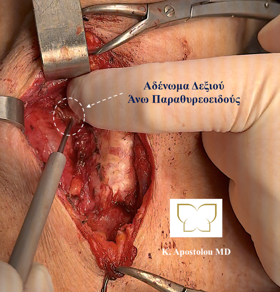 αδενωμα παραθυρεοειδους αδενα