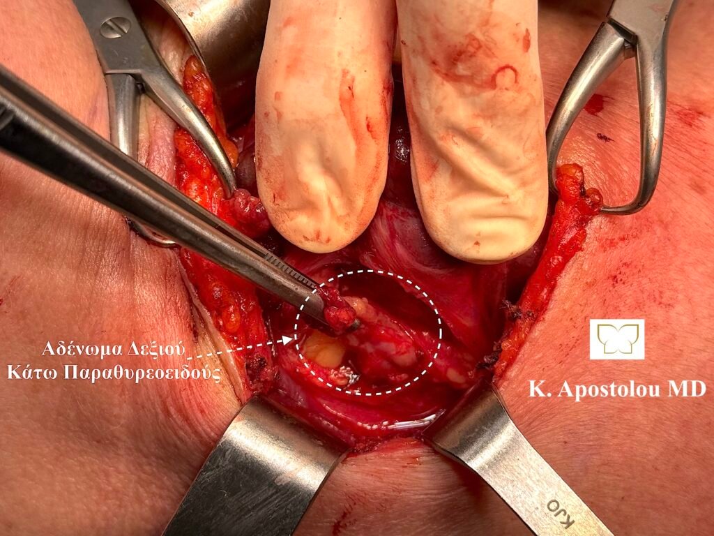 αδενωμα παραθυρεοειδους χειρουργειο