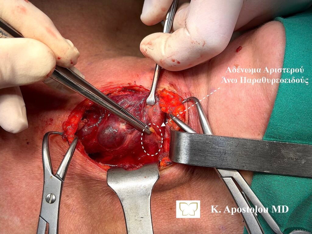 αδενωμα στον παραθυρεοειδη