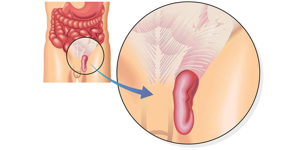 βουβωνοκήλη στους όρχεις