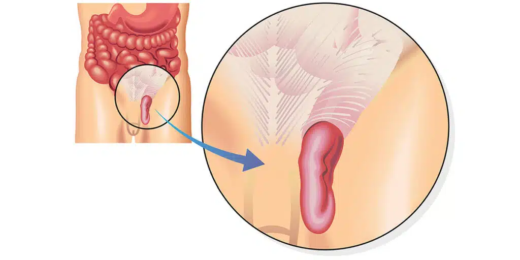βουβωνοκήλη στους όρχεις