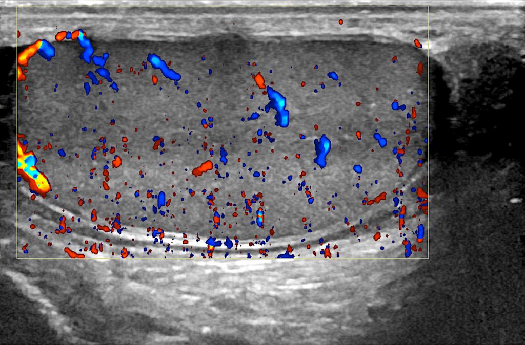 βουβωνοκήλη στους όρχεις συμπτώματα