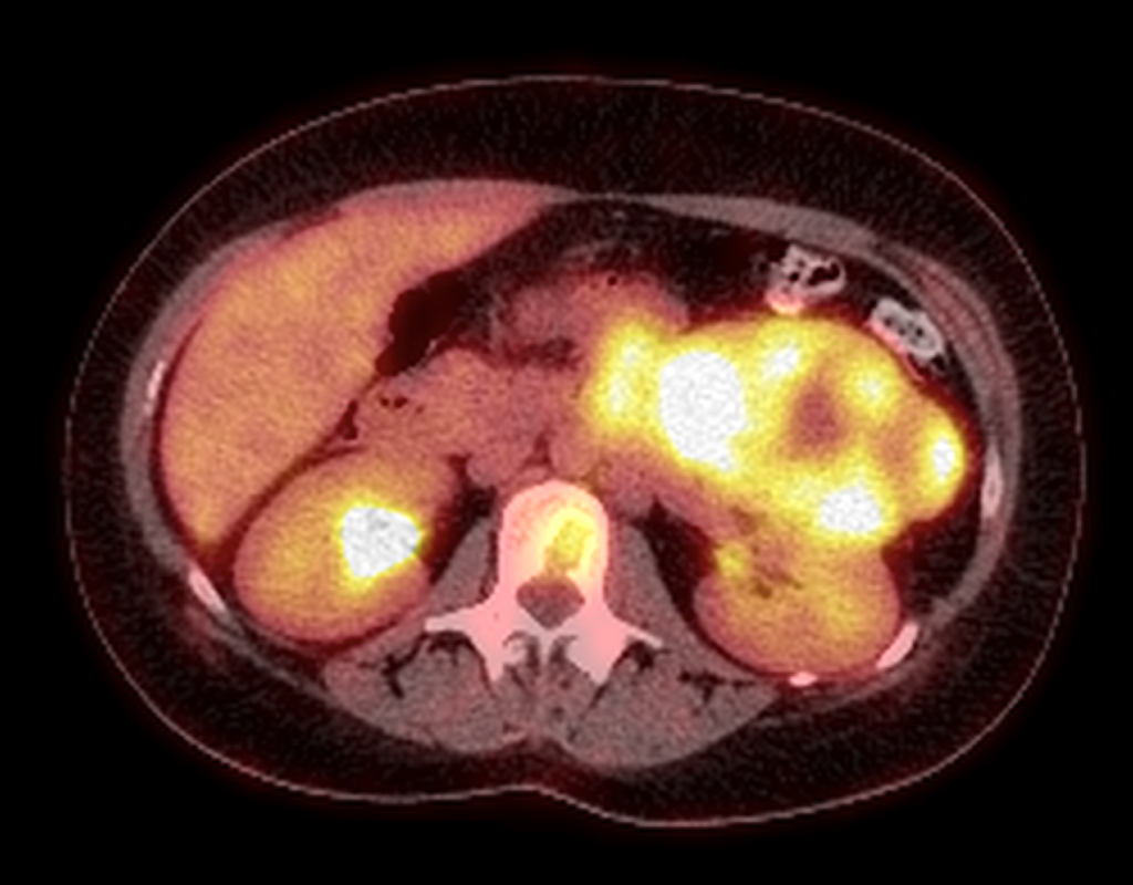 καρκίνος επινεφριδίων pet scan