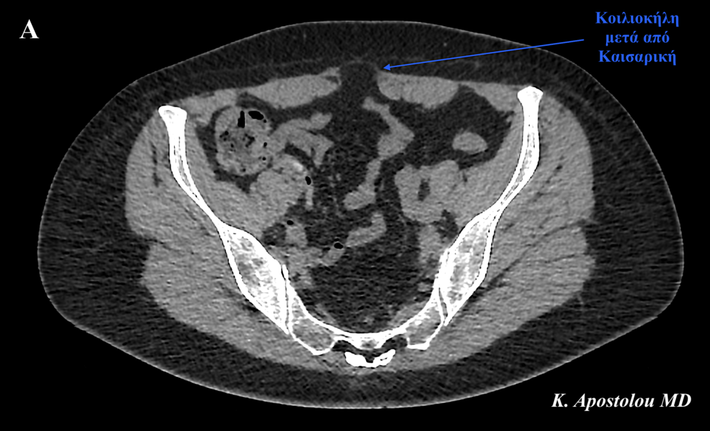 κηλη μετα απο καισαρικη