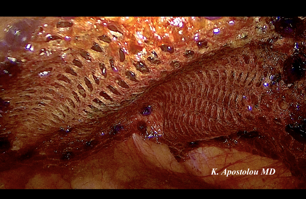 κηλη μετα απο καισαρικη θεραπεια