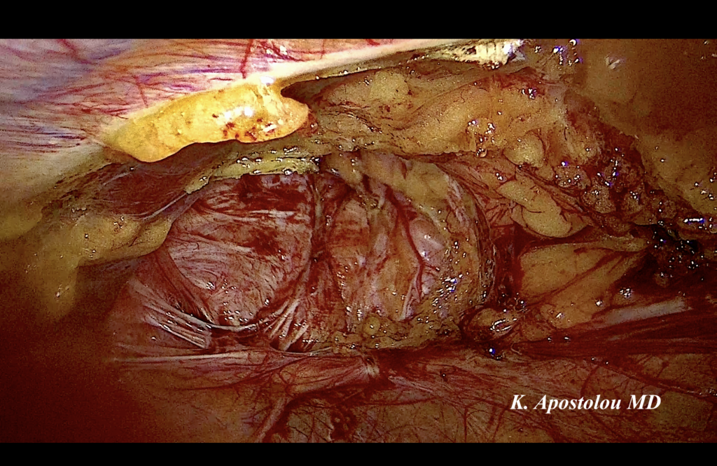 κηλη στην καισαρικη