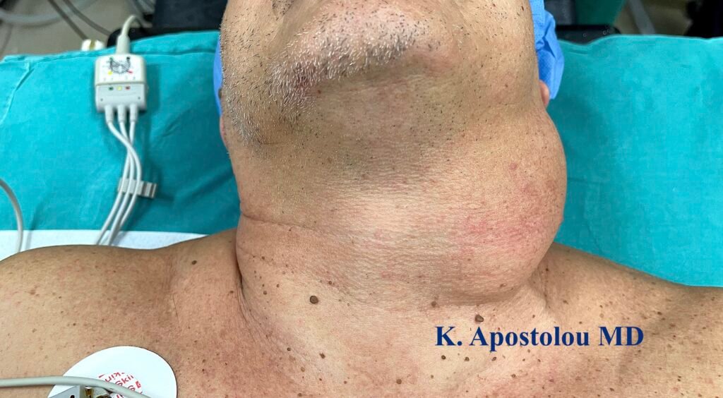 λιπωμα στο λαιμο