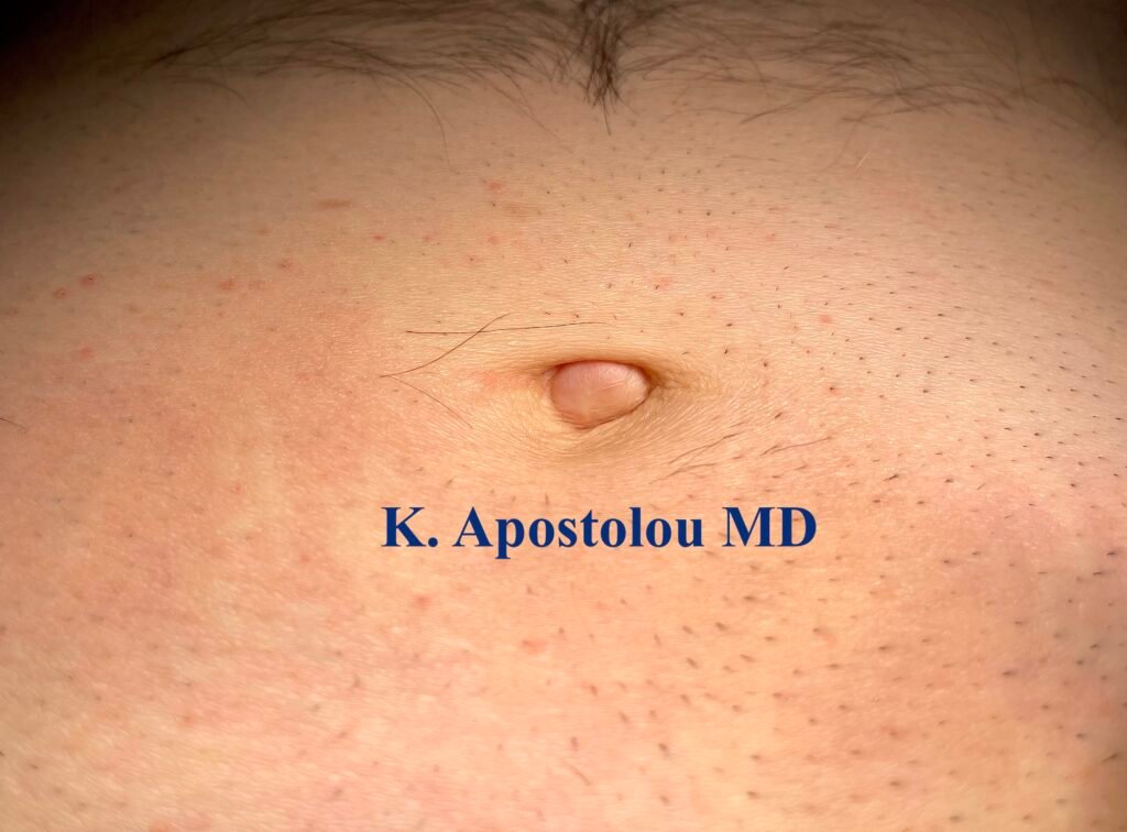 ομφαλοκήλη τι ειναι