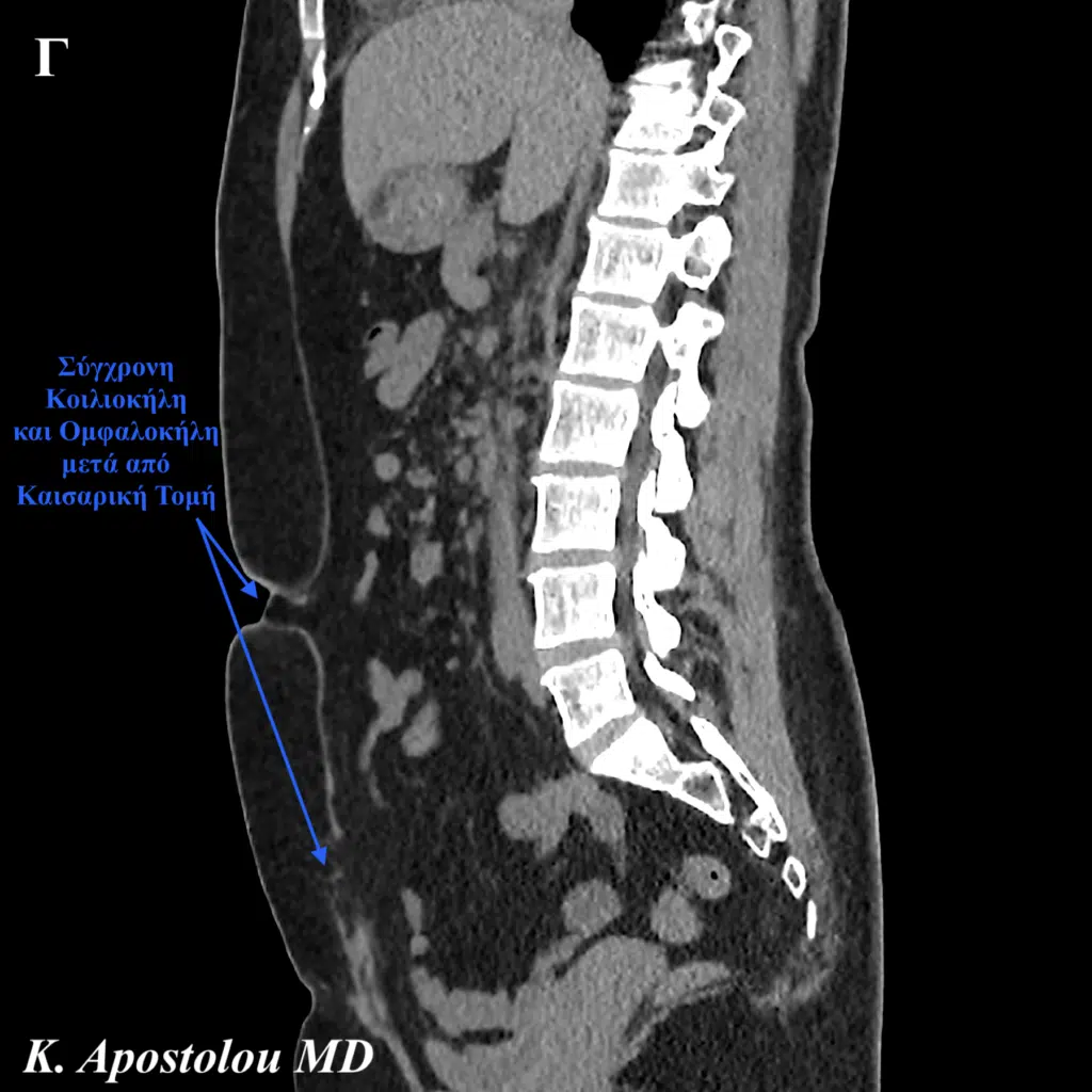 ομφαλοκηλη μετα απο καισαρικη