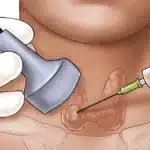 Βιοψία Θυρεοειδούς (FNA): Πότε γίνεται και τι δείχνει για τον καρκίνο θυρεοειδούς;