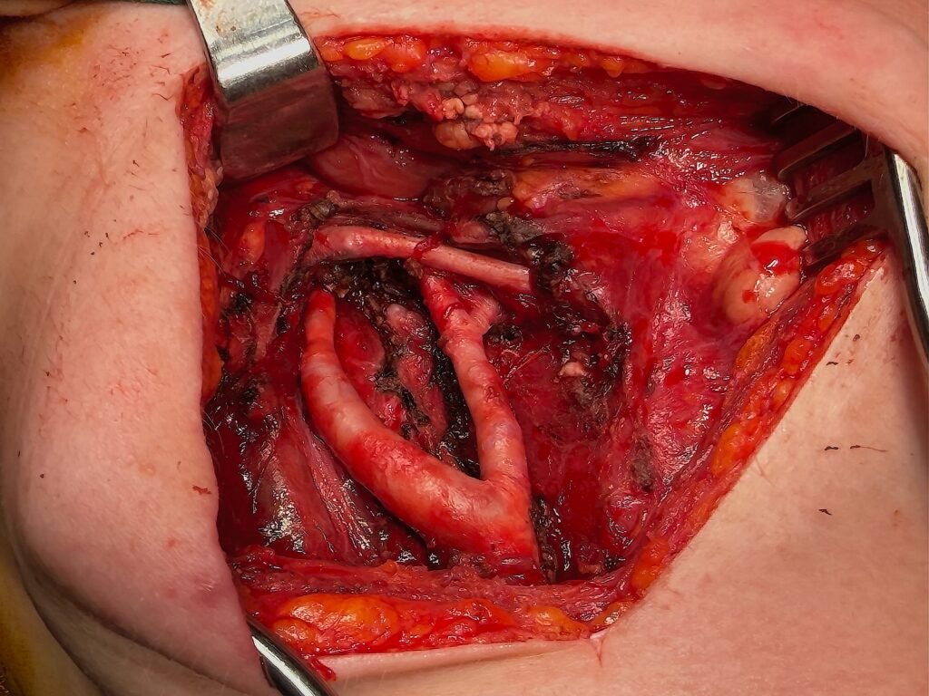 ογκος καρωτιδικου σωματιου θεραπεια