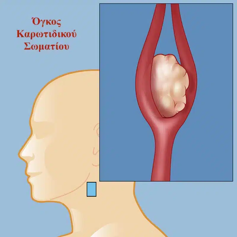ογκος καρωτιδικου σωματιου