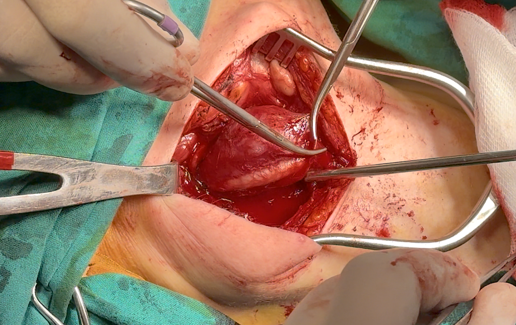 παραγαγγλίωμα καρωτίδας