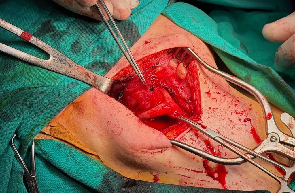 όγκος καρωτιδικού σωματίου χειρουργείο