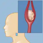 Όγκος Καρωτιδικού Σωματίου