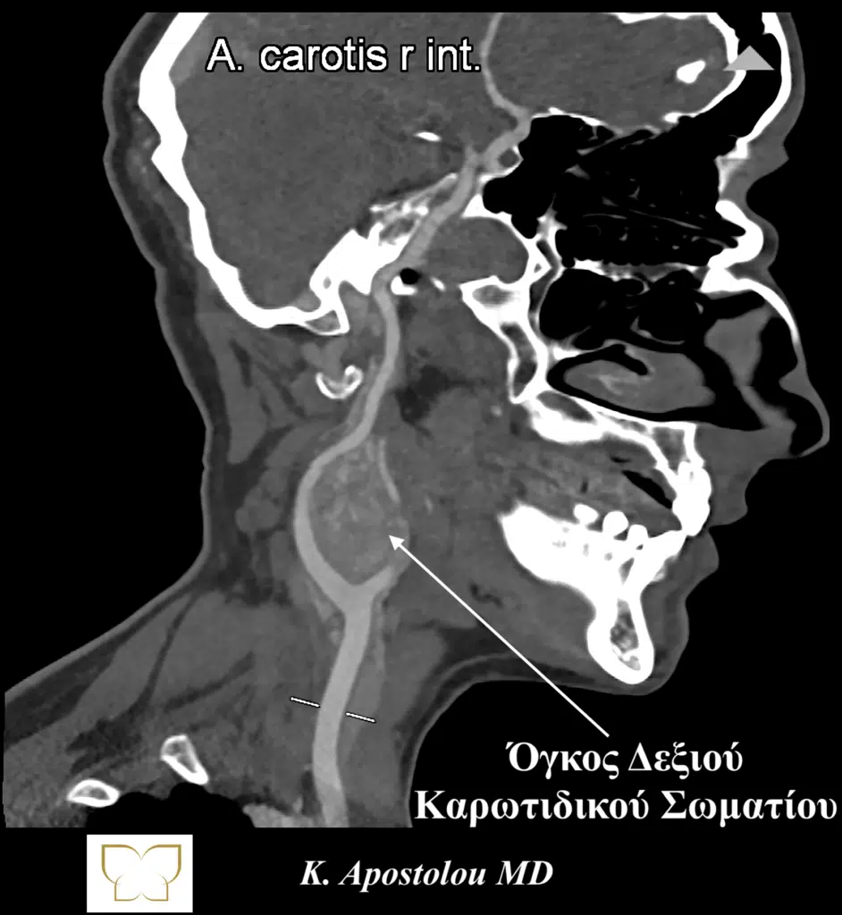 όγκος καρωτιδικού σωματίου